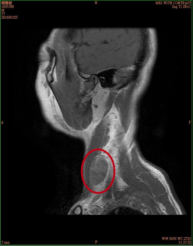 2賴鵬智左頸下方腫塊三總磁振造影影像-1-20160125-後製.jpg - 日誌用相簿