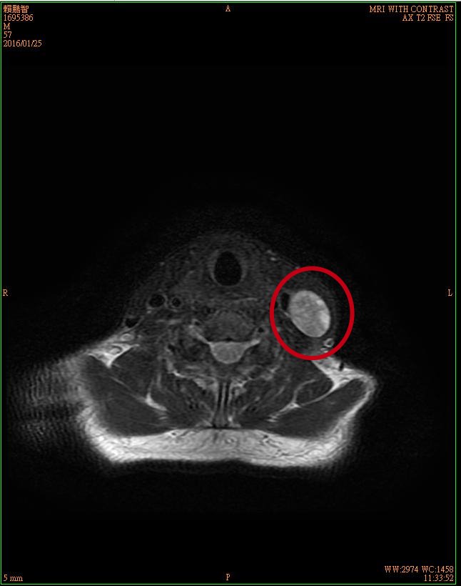 1賴鵬智左頸下方腫塊三總磁振造影影像-2-20160125-後製.jpg - 日誌用相簿