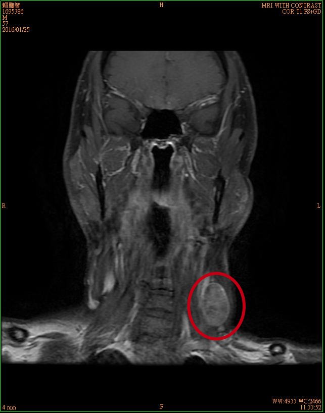 3賴鵬智左頸下方腫塊三總磁振造影影像-3-20160125-後製.jpg - 日誌用相簿